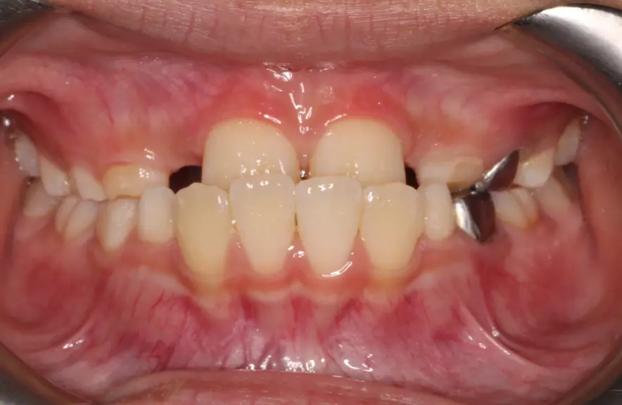Before Intraoral Centre Tooth Photo