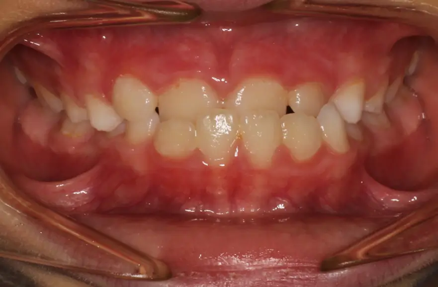 Before Intraoral Centre Tooth Photo