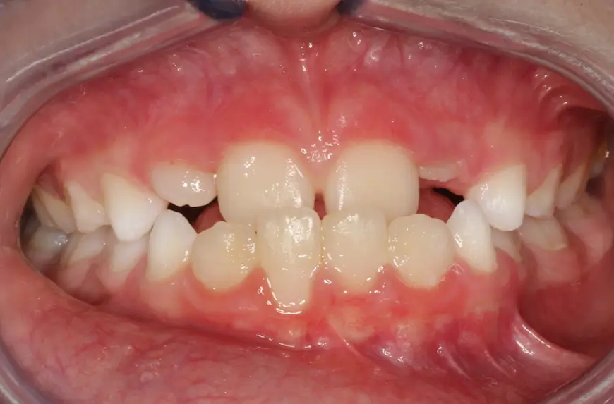 Before Intraoral Centre Tooth Photo