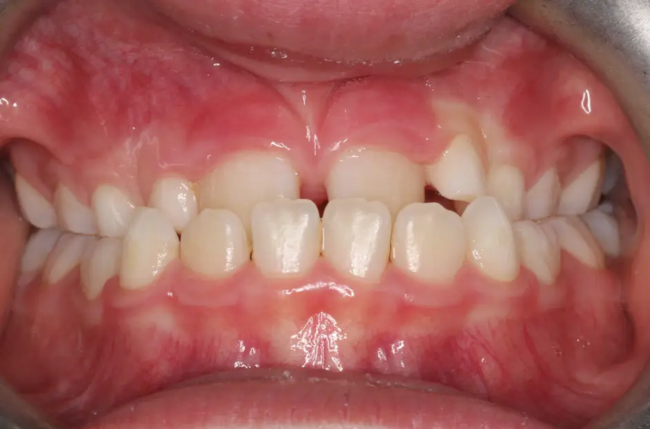 Before Intraoral Centre Tooth Photo