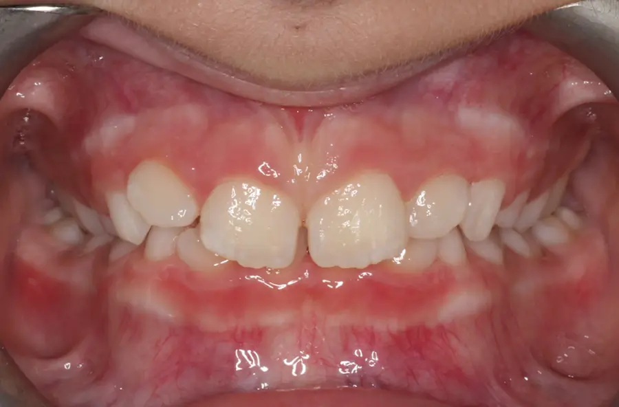 Before Intraoral Centre Tooth Photo
