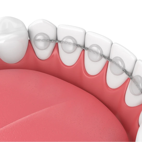 lingual-bonded-retainer-fixed-permanent-bar-glued-to-teeth lingual-bonded-retainer-fixed-permanent-bar-glued-to-teeth
