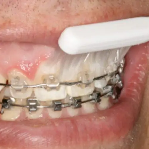 orthodontist-vaughan-additional-care-information-brushing-three Orthodontist Vaughan Additional Care Information Brushing Three