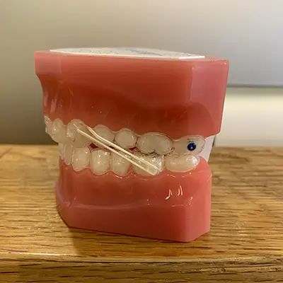 Orthodontist Vaughan Elastics and Button