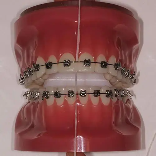 orthodontist-vaughan-flossing-with-braces-flossing-step-three Orthodontist Vaughan Flossing with Braces Flossing Step Three