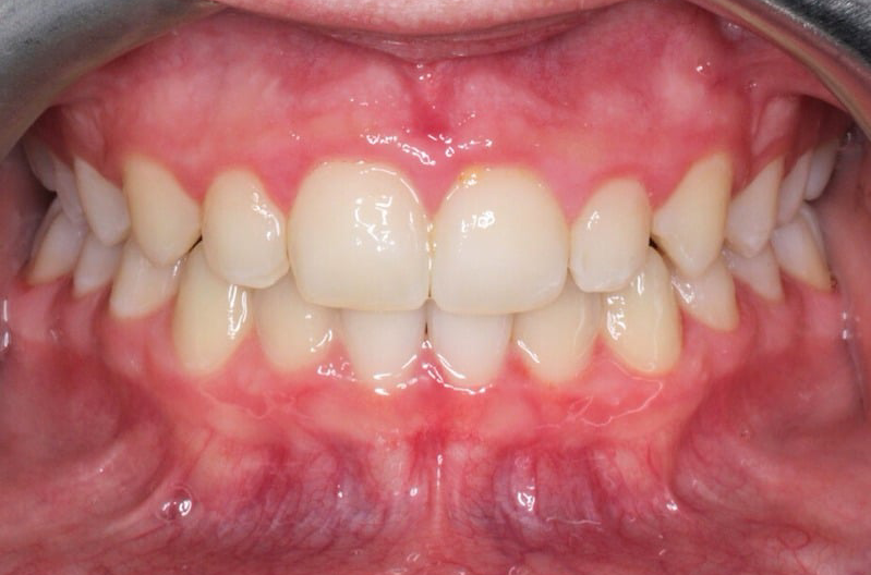 Orthodontist Vaughan Imnvisalign After One