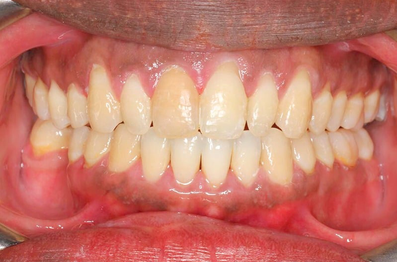 Orthodontist Vaughan Imnvisalign After Three