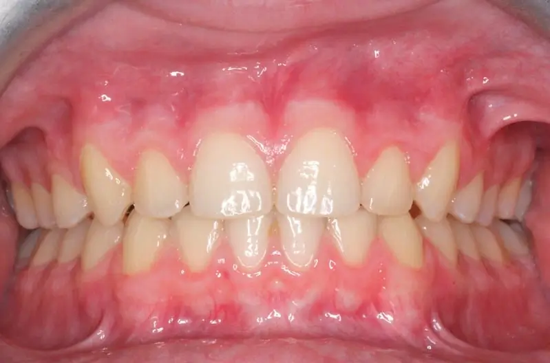 Orthodontist Vaughan Imnvisalign After Two