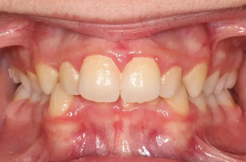 Orthodontist Vaughan Imnvisalign Before One