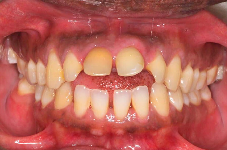 Orthodontist Vaughan Imnvisalign Before Three