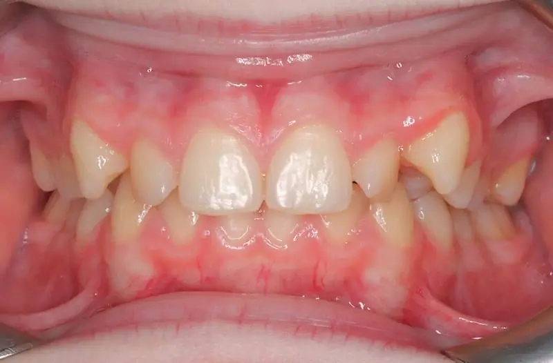 Orthodontist Vaughan Imnvisalign Before Two