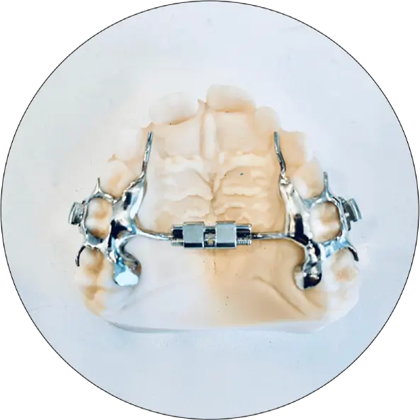 our-palatal-expanders-are-separator-less our-palatal-expanders-are-separator-less