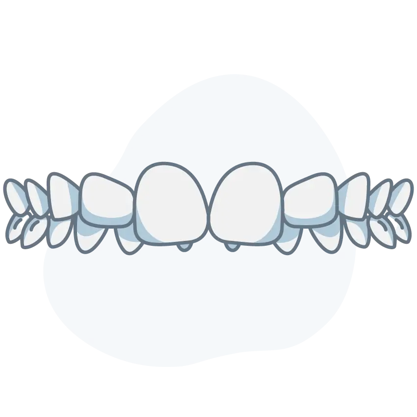 overbite overbite