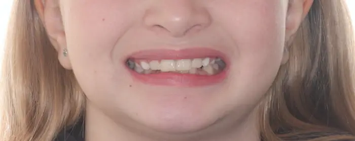 After Facial Smiling Photo
