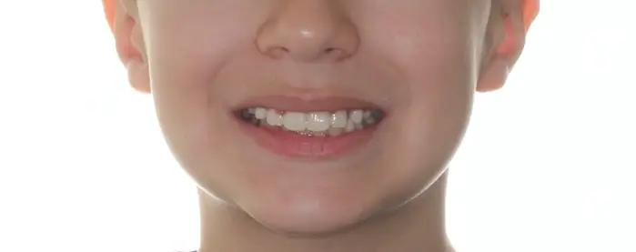 After Facial Smiling Photo