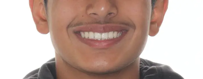 After Facial Smiling Photo