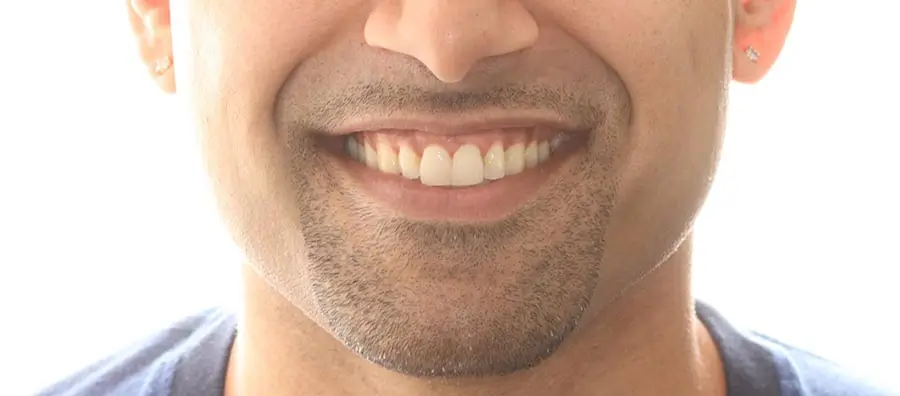 After Facial Smiling Photo