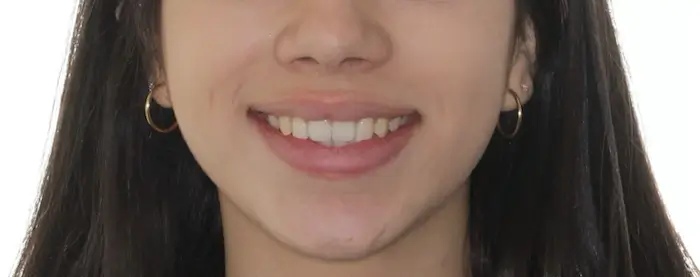 After Facial Smiling Photo