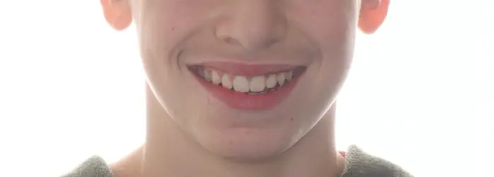 After Facial Smiling Photo