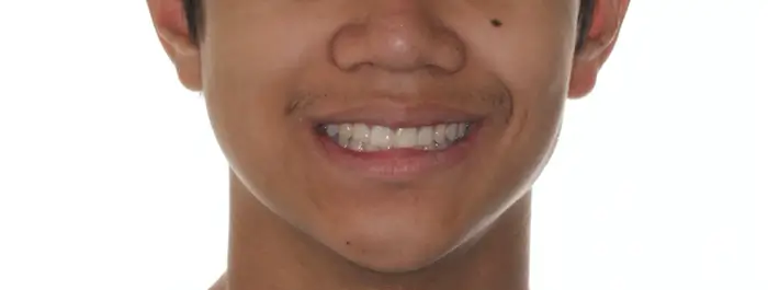 After Facial Smiling Photo