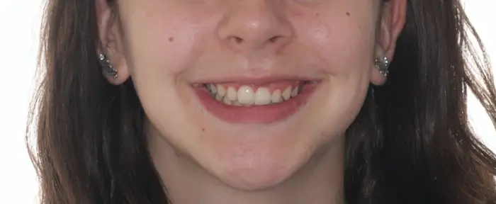 After Facial Smiling Photo