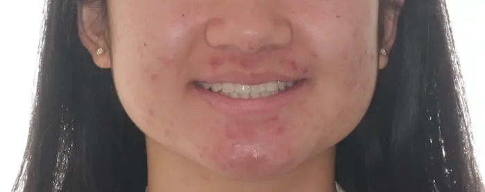 After Facial Smiling Photo