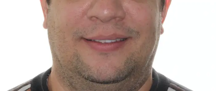 After Facial Smiling Photo