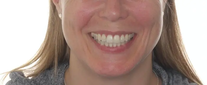 After Facial Smiling Photo