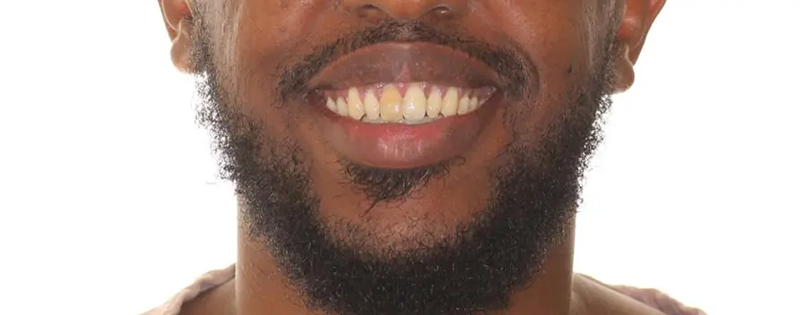 After Facial Smiling Photo