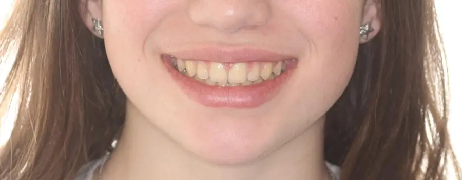 Before Facial Smiling Photo