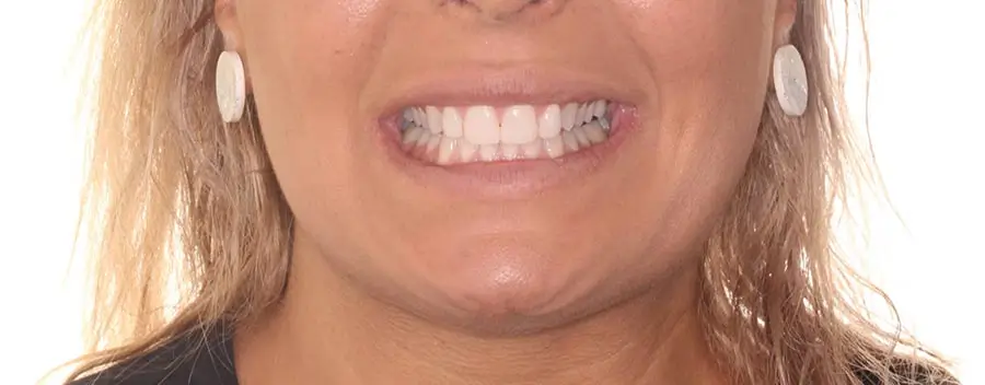 After Facial Smiling Photo