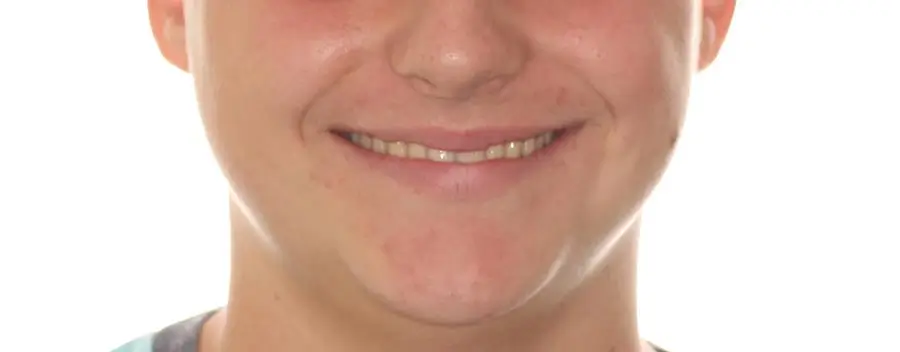 After Facial Smiling Photo