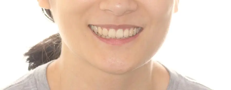After Facial Smiling Photo