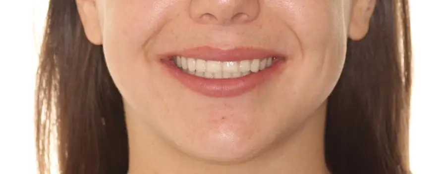 After Facial Smiling Photo
