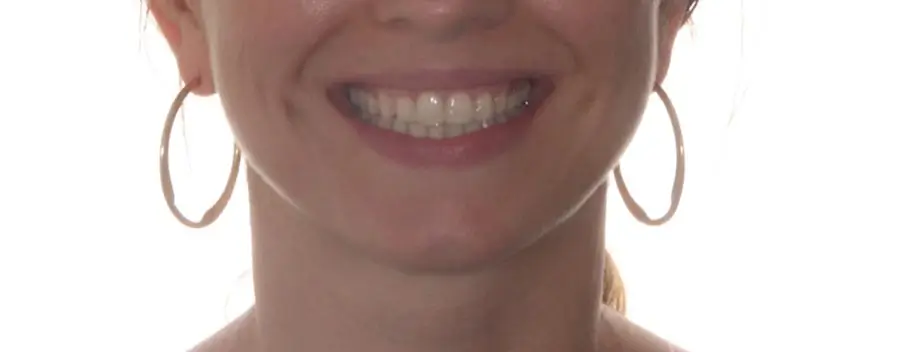 After Facial Smiling Photo