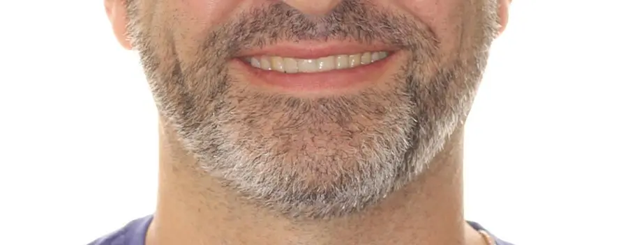 After Facial Smiling Photo