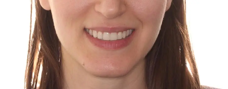 After Facial Smiling Photo