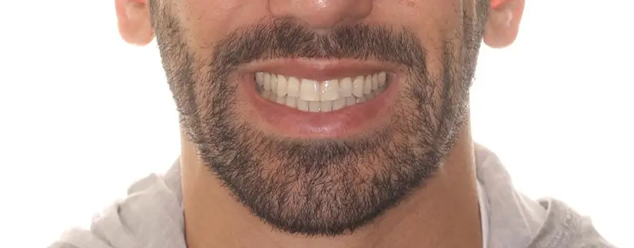 After Facial Smiling Photo