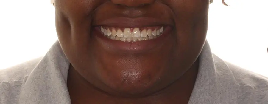After Facial Smiling Photo