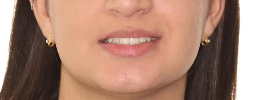 After Facial Smiling Photo