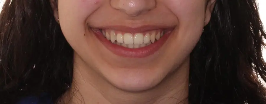 After Facial Smiling Photo