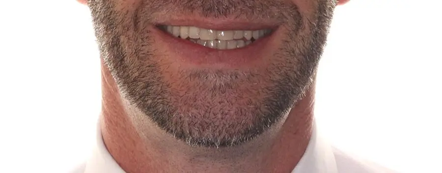 After Facial Smiling Photo
