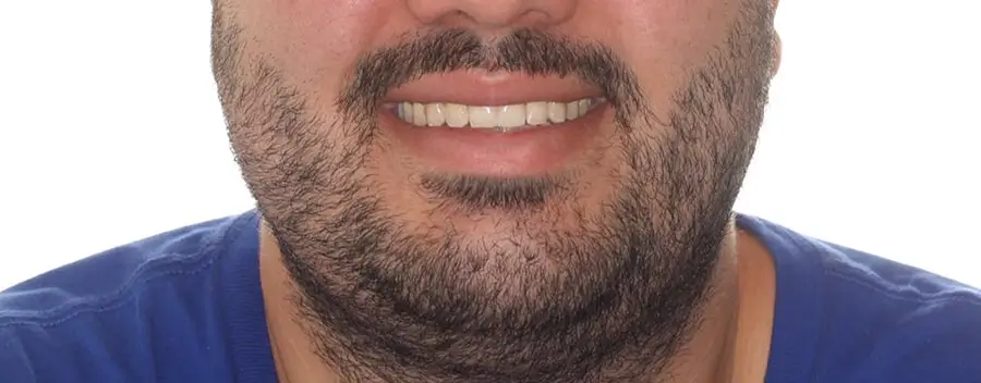 After Facial Smiling Photo
