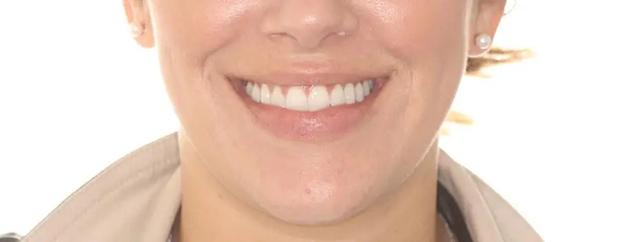 After Facial Smiling Photo