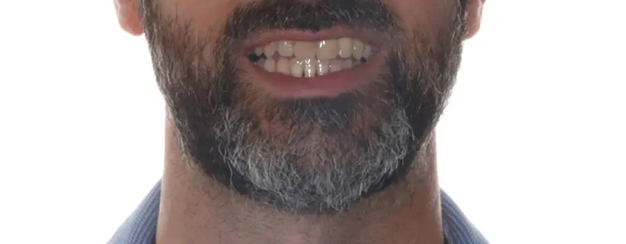 After Facial Smiling Photo