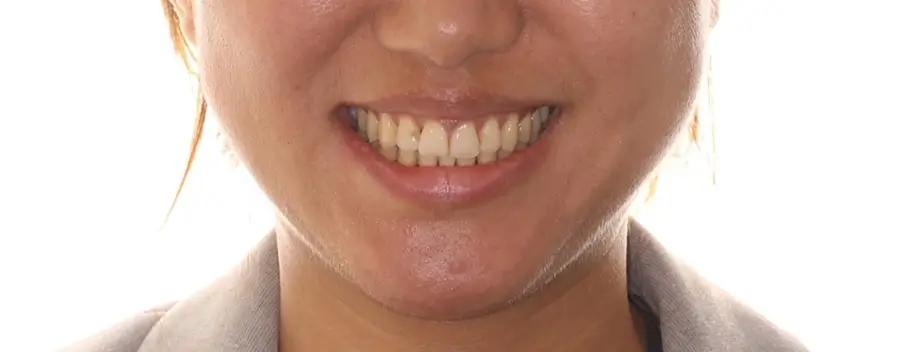 After Facial Smiling Photo