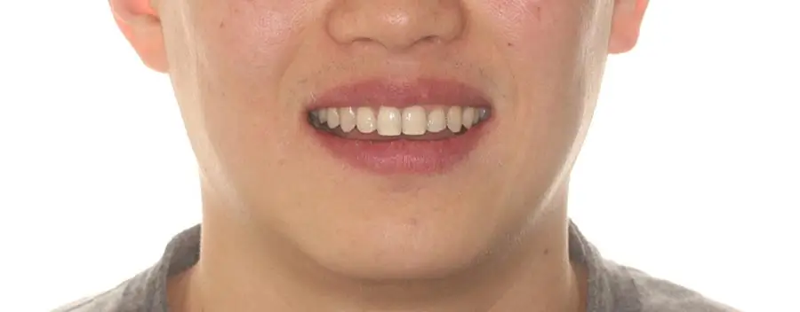 After Facial Smiling Photo