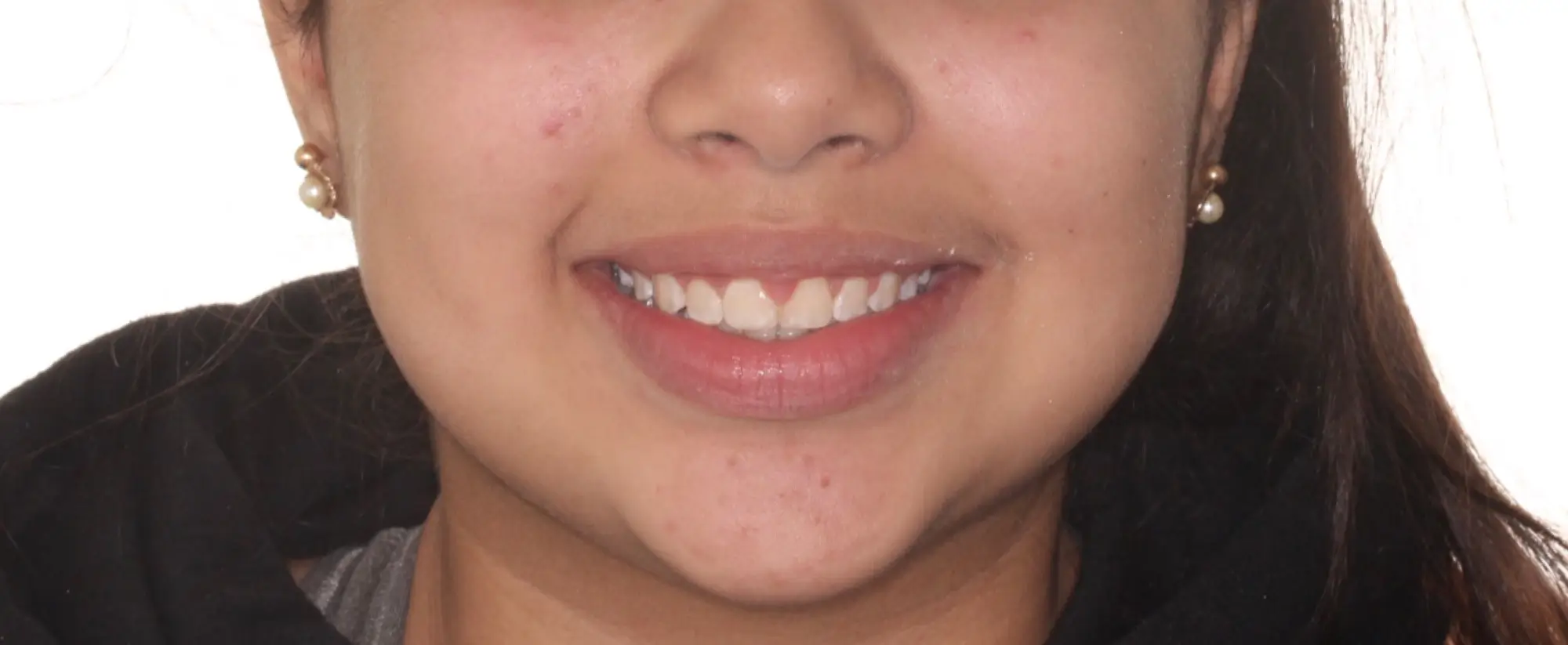 After Facial Smiling Photo