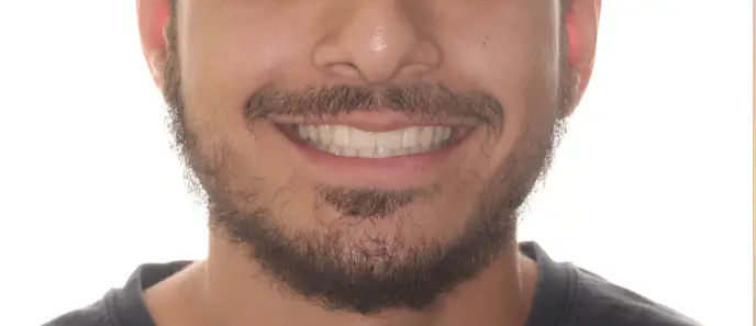 After Facial Smiling Photo
