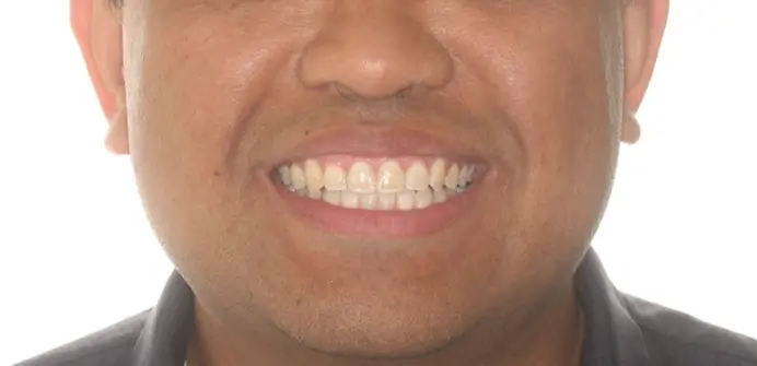 After Facial Smiling Photo